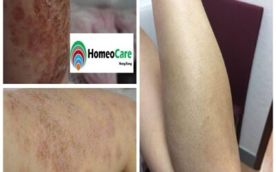 Understanding Eczema: Best Homeopathic Remedies Based on Individual Symptoms