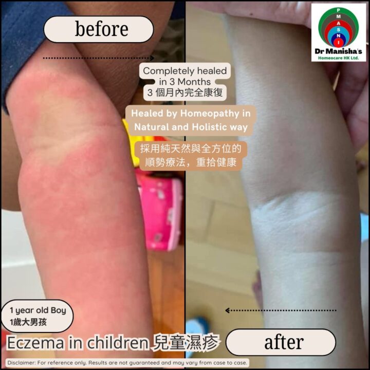1yrBoyEzcema
